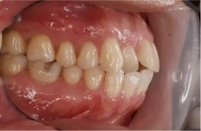 症例A 施術前写真その2