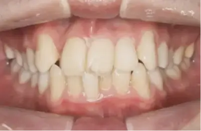 症例B 施術前写真その1