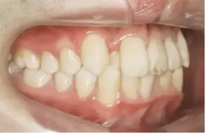 症例B 施術前写真その2