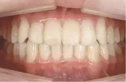 症例B 施術後写真その1