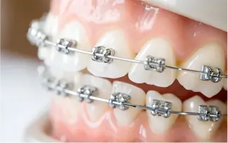 ワイヤー矯正イメージ