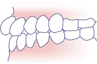 上顎前突（出っ歯） イメージ