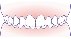 過蓋咬合（かみ合わせが深い） イメージ