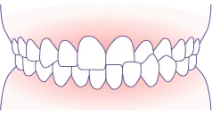 クロスバイト（交叉咬合） イメージ