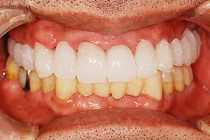 「仮歯」によるイメージのすり合わせ