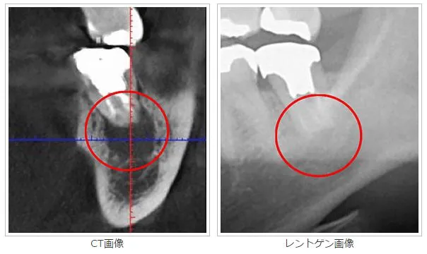 デンタルレントゲン