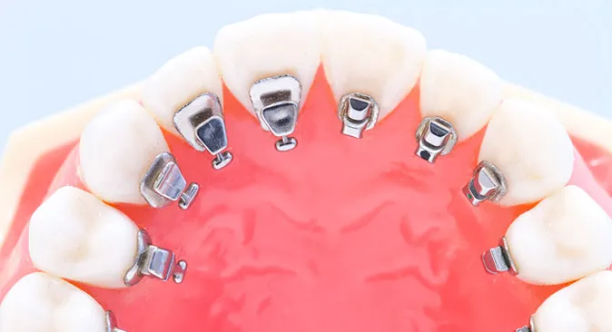 目立ちにくい矯正