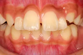 前歯の部分矯正