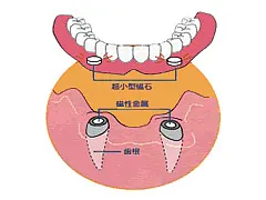 磁性アタッチメントデンチャー