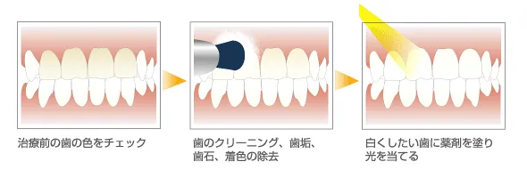 オフィスホワイトニング