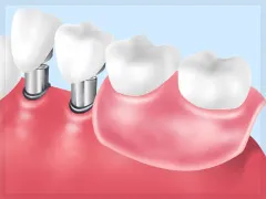 コーヌスクローネ義歯