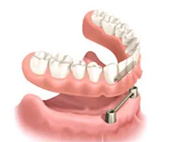 インプラントオーバーデンチャー