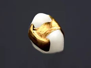 ゴールドインレー（大臼歯。隣接面含む）