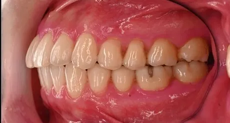 症例A 治療後5