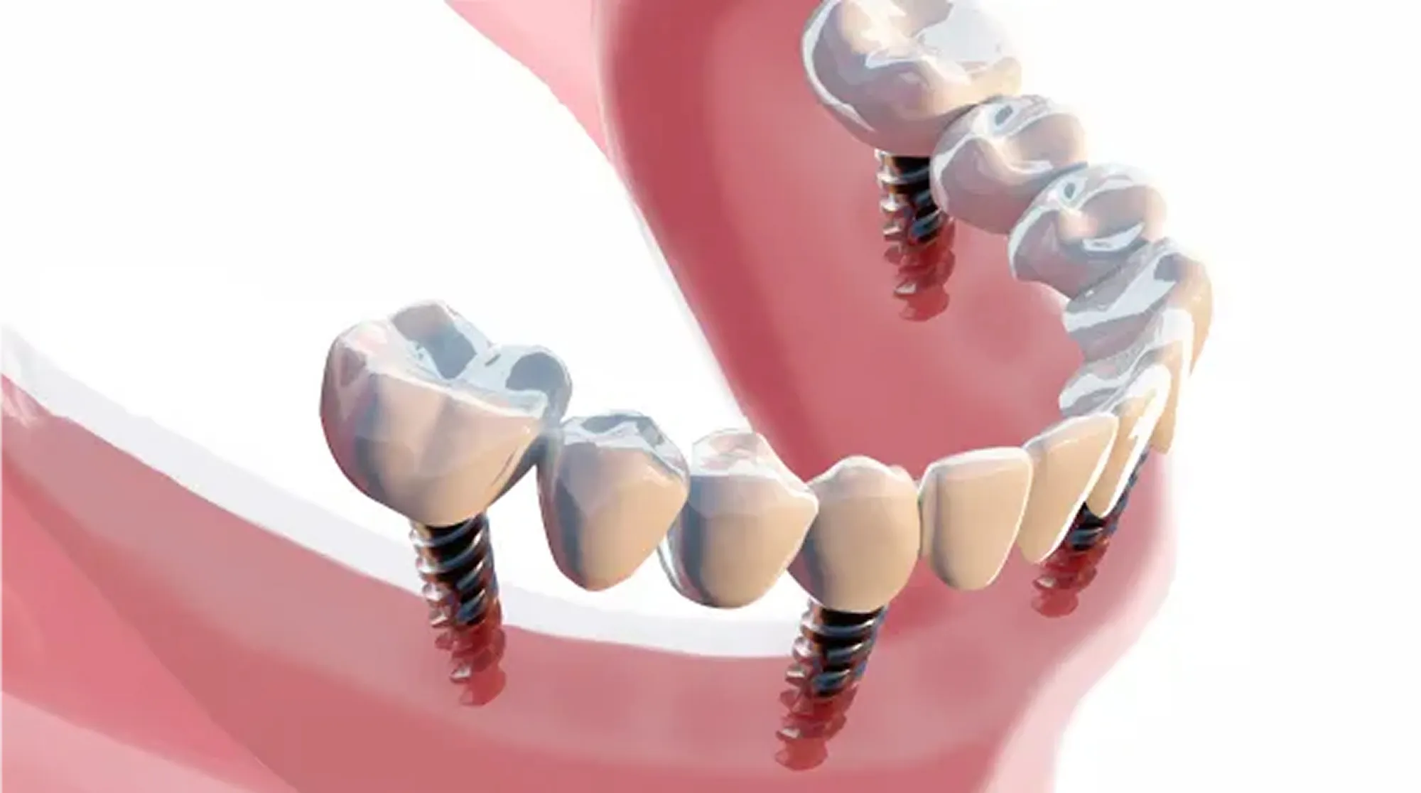 オールオン4・6