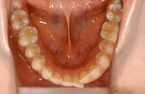 後戻りした歯並びの再矯正の例