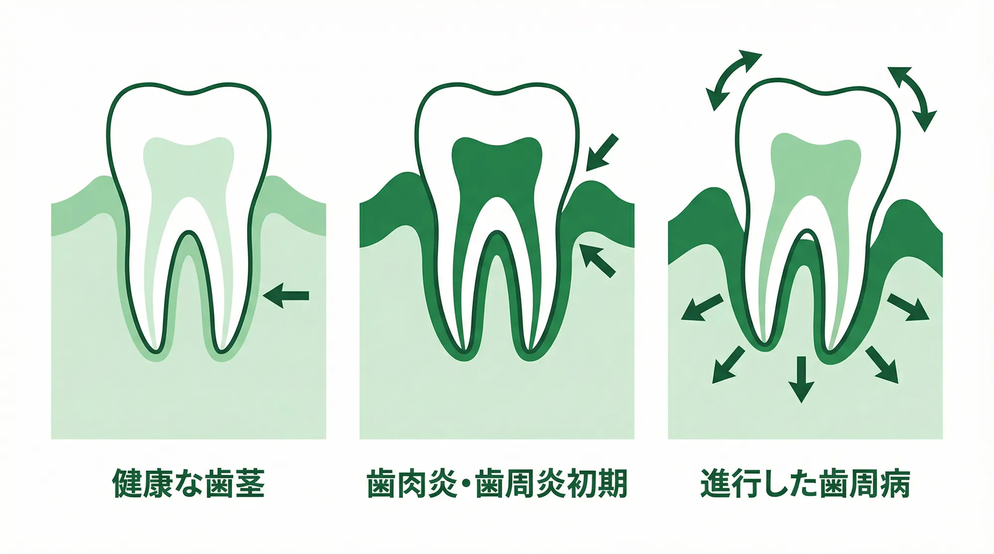 歯周病で歯全体がグラグラしている方
