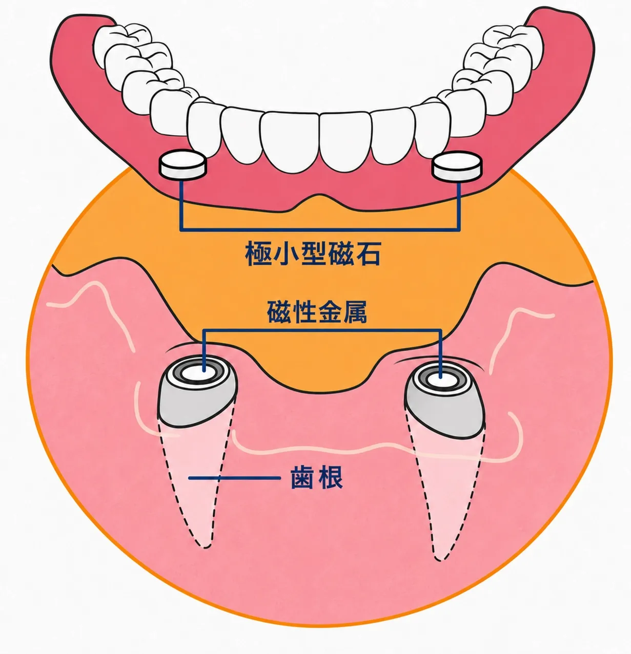 磁性アタッチメントデンチャー